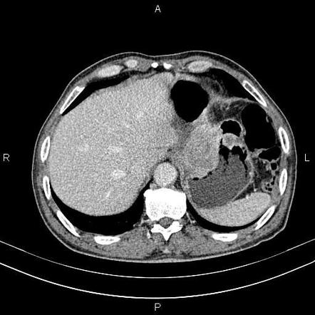 Gastric adenocarcinoma | Radiology Reference Article | Radiopaedia.org