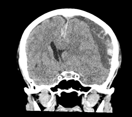 Acute on chronic subdural hemorrhage | Radiology Case | Radiopaedia.org