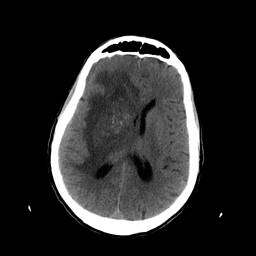 Acute necrotizing toxoplasma encephalitis | Image | Radiopaedia.org