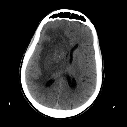 Acute necrotizing toxoplasma encephalitis | Image | Radiopaedia.org