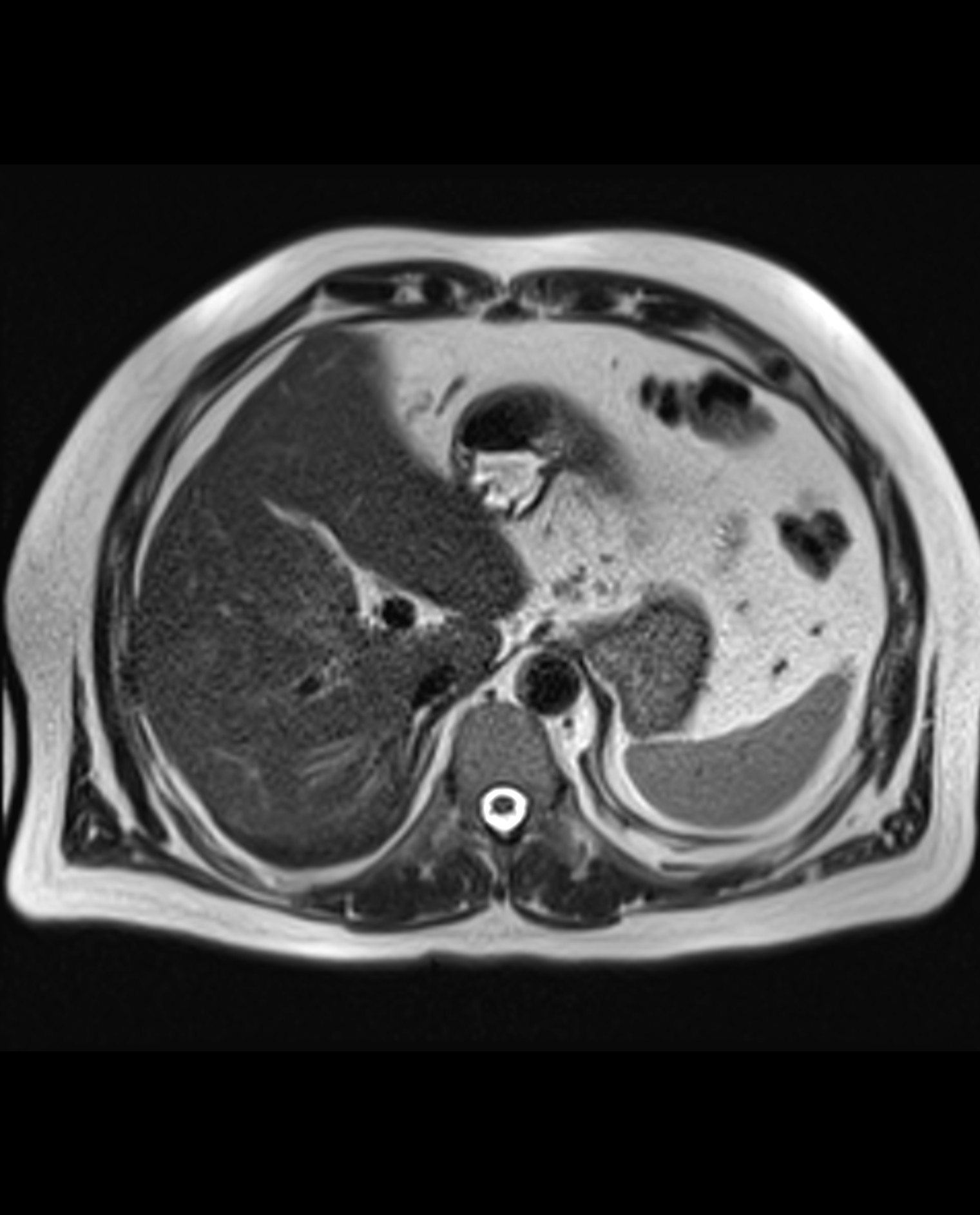 Focal hepatic steatosis | Image | Radiopaedia.org