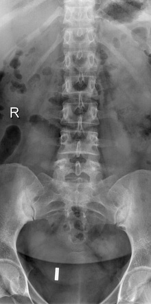 Sacroiliitis | Radiology Case | Radiopaedia.org