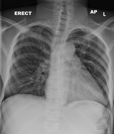 Sickle cell disease | Radiology Case | Radiopaedia.org