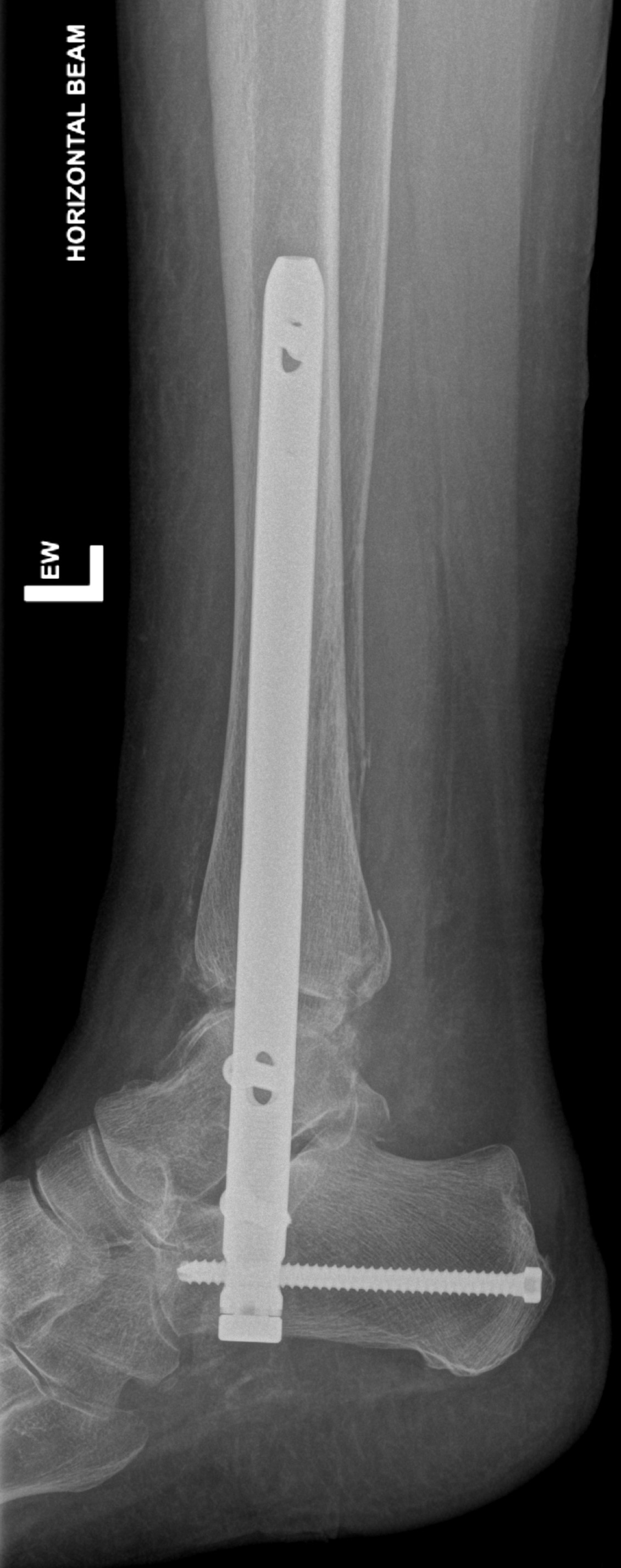 trimalleolar-fracture-image-radiopaedia