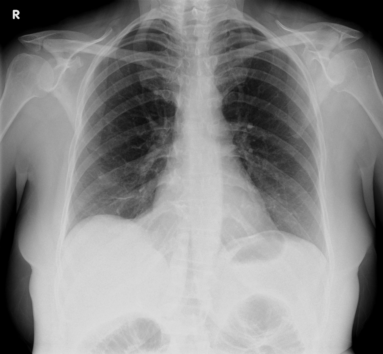 High grade distal small bowel obstruction | Image | Radiopaedia.org