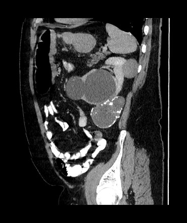 Papillary Renal Cell Carcinoma Radiology Reference Article Radiopaedia Org