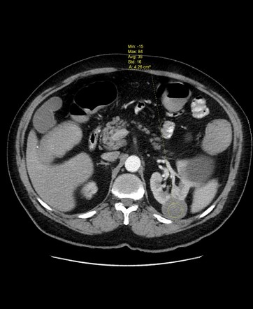 Synchronous renal and colonic carcinomas | Image | Radiopaedia.org