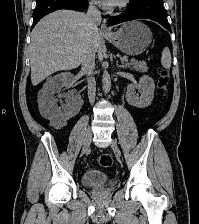 Localised cystic renal disease | Radiology Reference Article ...