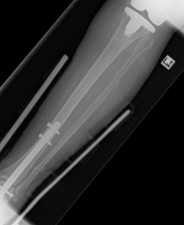 Trimalleolar fracture | Image | Radiopaedia.org