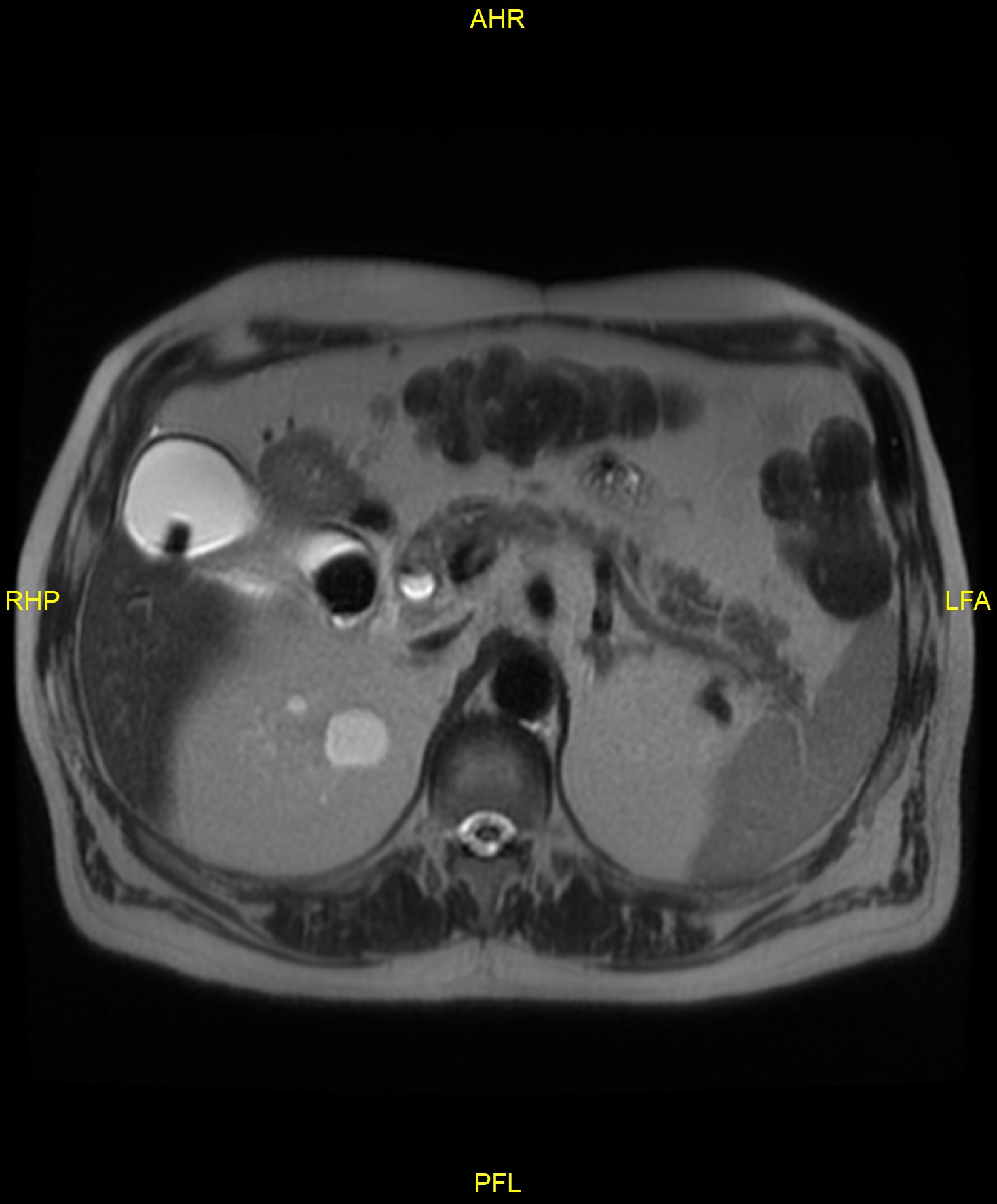 cholelithiasis-and-choledocholithiasis-image-radiopaedia