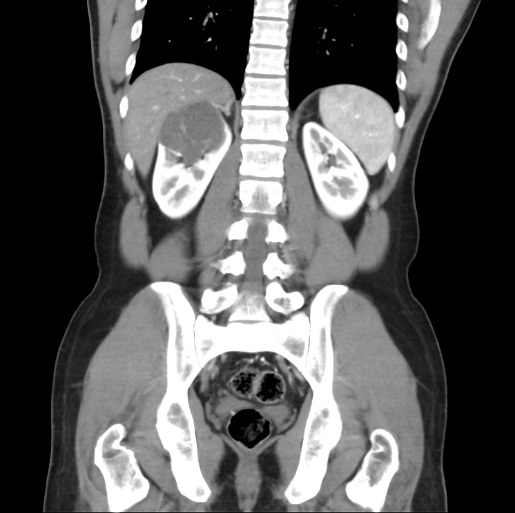 Multilocular cystic renal neoplasm of low malignant potential | Image ...