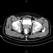 Rectal Cancer | Radiology Reference Article | Radiopaedia.org