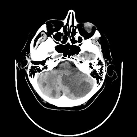 cerebellar stroke case study