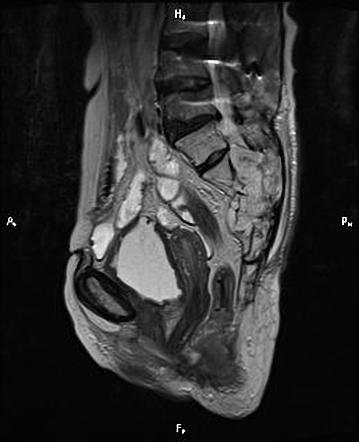 Sacral chordoma | Image | Radiopaedia.org