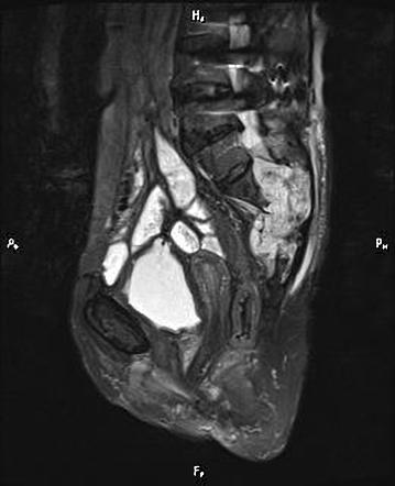 Sacral chordoma | Image | Radiopaedia.org