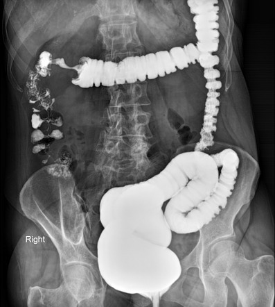 Apple Core Sign Colon Radiology Reference Article Radiopaedia Org