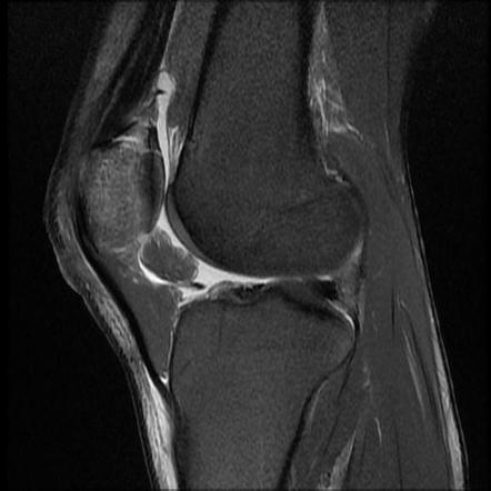 Patellar fracture | Radiology Reference Article | Radiopaedia.org