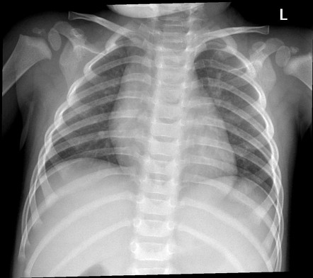 Posterior Ribs X Ray