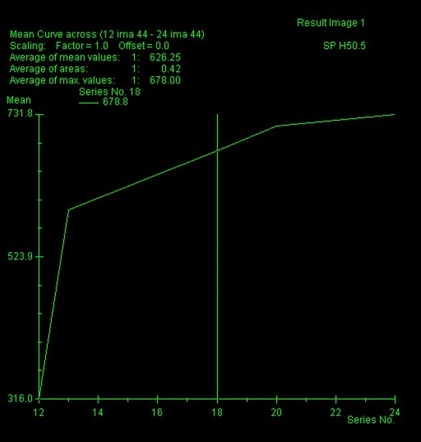 Breast MRI enhancement curves | Radiology Reference Article ...