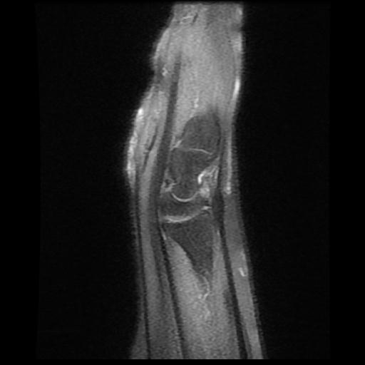 Extensor Carpi Ulnaris Tendon Split Tear Image