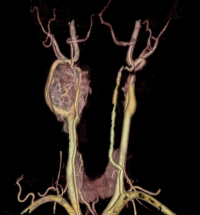 Carotid Body Tumor Image Radiopaedia Org