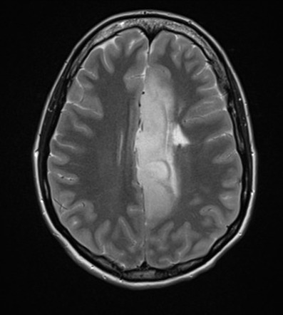 Diffuse astrocytoma of the left cingulate gyrus | Radiology Case ...