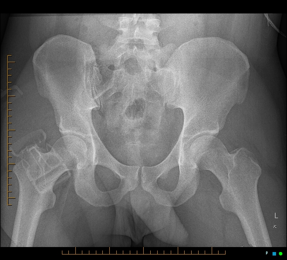 Cerebral fat embolism | Image | Radiopaedia.org