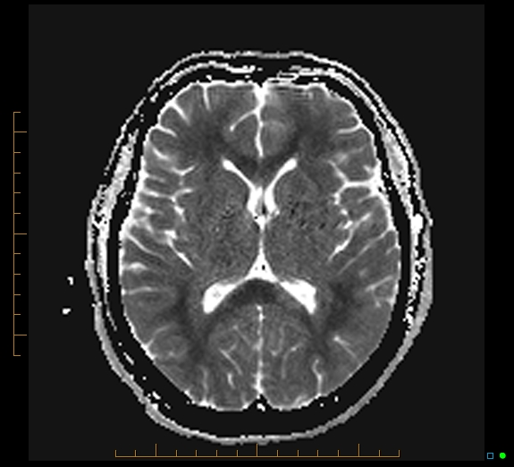 Cerebral fat embolism | Image | Radiopaedia.org