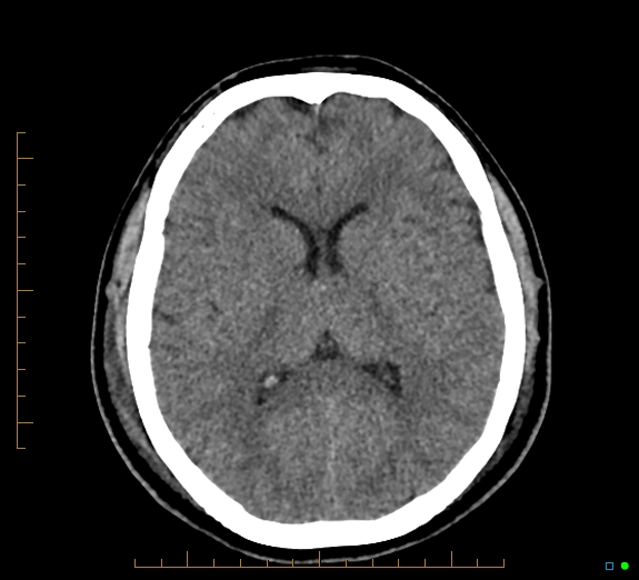 Cerebral fat embolism | Image | Radiopaedia.org