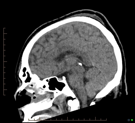 Cerebral fat embolism | Image | Radiopaedia.org