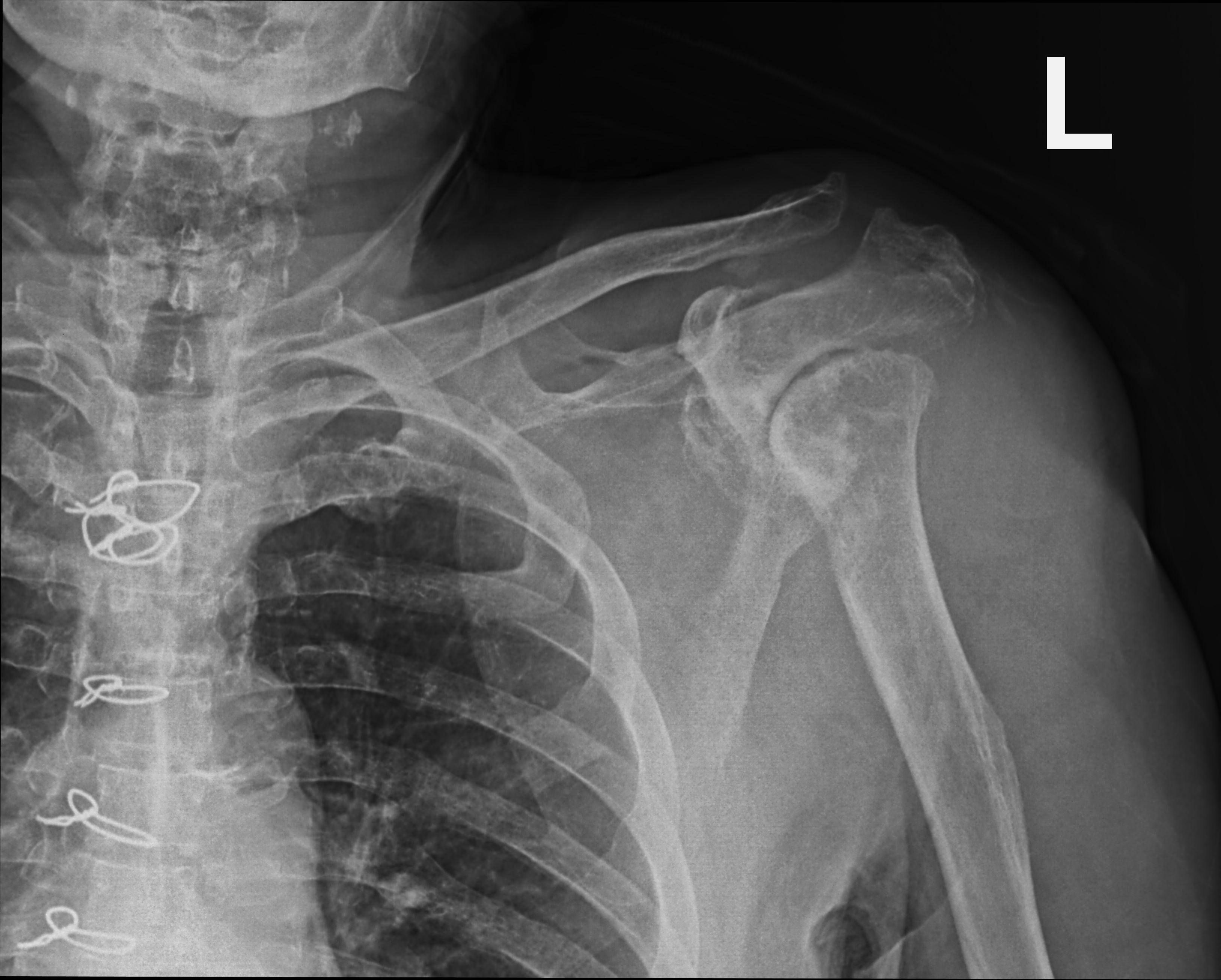 Neuropathic Osteoarthropathy - Shoulder Joint 