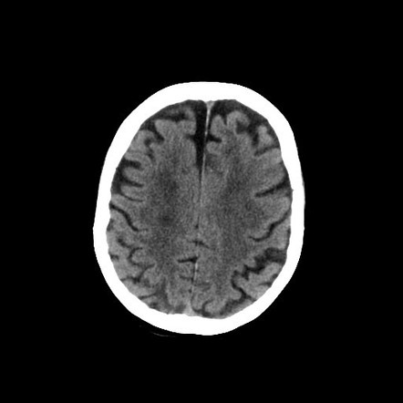 Posterior Inferior Cerebellar Artery Cta