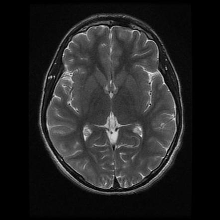 Isolated hypoglossal nerve paralysis | Image | Radiopaedia.org