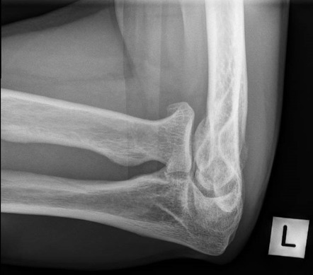 Elbow (Coyle's view) | Radiology Reference Article | Radiopaedia.org