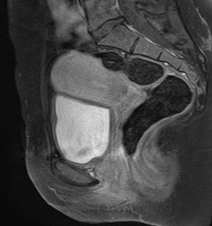 Ovarian endometrioma | Image | Radiopaedia.org