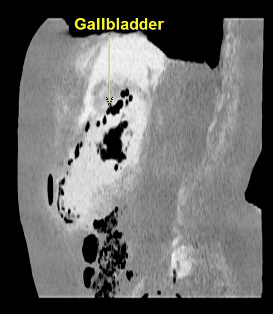 Complicated Emphysematous Cholecystitis | Image | Radiopaedia.org