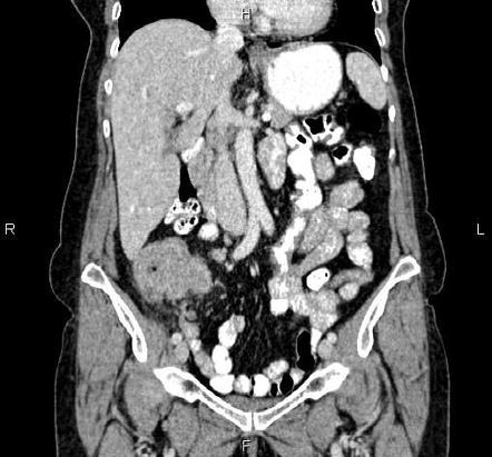 Cecal cancer | Radiology Case | Radiopaedia.org