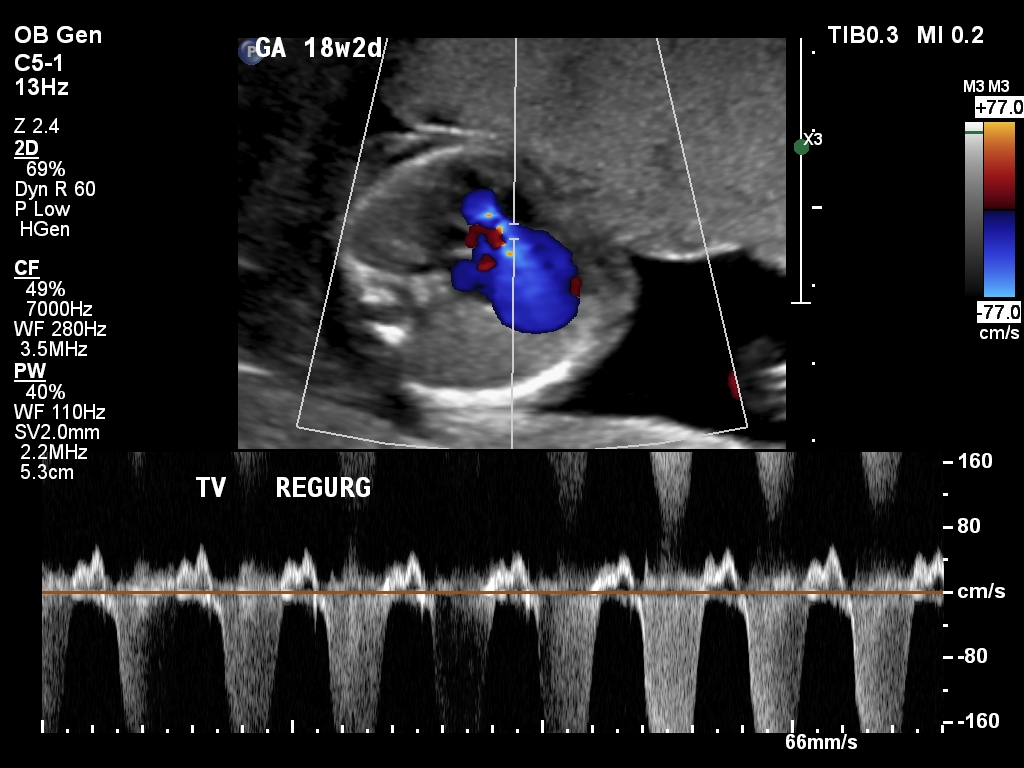 Ultrasound Fetal Heart Anomalies