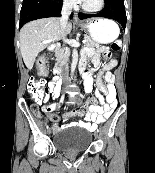 Colon adenocarcinoma - hepatic flexure | Image | Radiopaedia.org