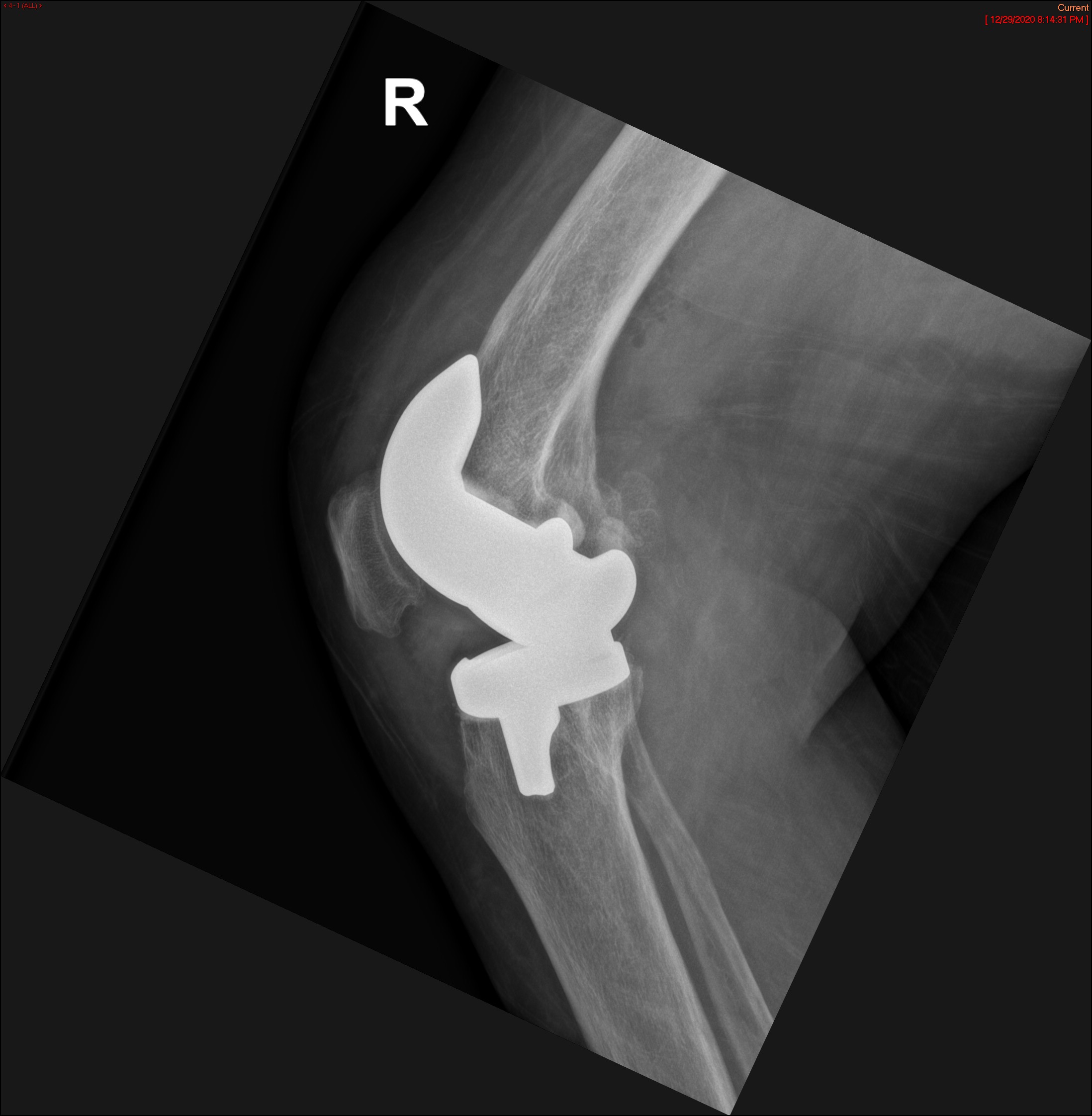 Deep Muscular Abscess Image