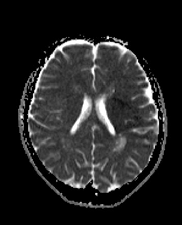 Dilated perivascular spaces mimicking a multicystic neoplasm | Image ...