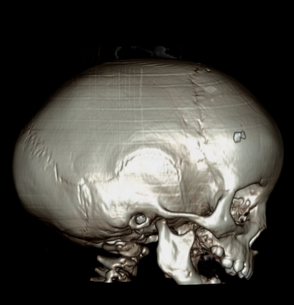 Scaphocephaly | Radiology Reference Article | Radiopaedia.org