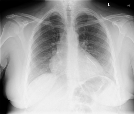 Airway foreign bodies in adults | Radiology Reference Article ...