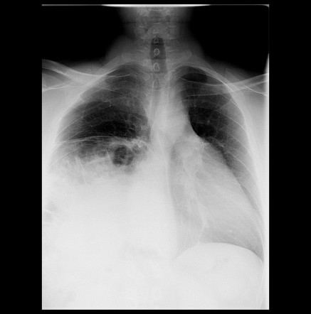 Phrenic nerve palsy | Radiology Reference Article | Radiopaedia.org