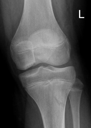 Osteochondral defect | Radiology Case | Radiopaedia.org