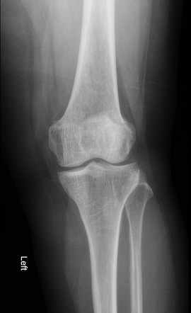 Bipartite patella | Radiology Reference Article | Radiopaedia.org