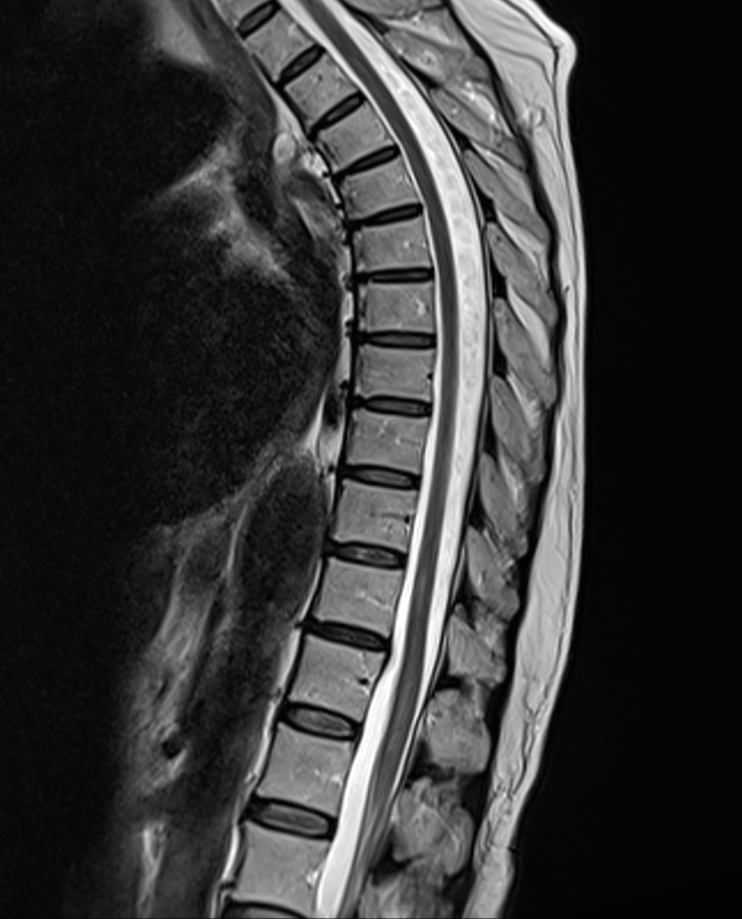 Transverse myelitis - temporal evolution | Image | Radiopaedia.org