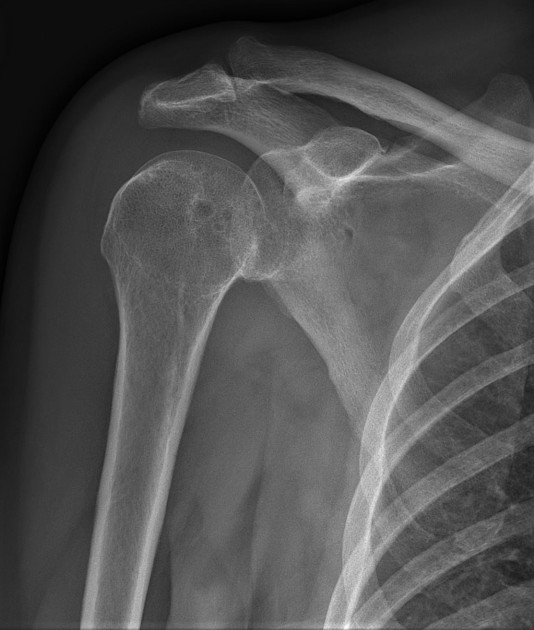 Velpeau view of the shoulder, Radiology Case