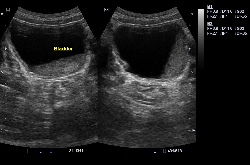 Bladder Debris | Image | Radiopaedia.org