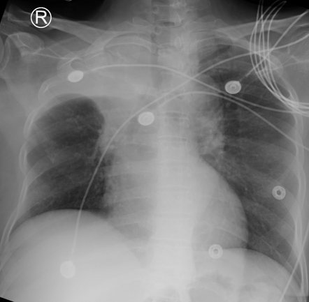 Golden S sign of right upper lobe collapse | Radiology Case ...